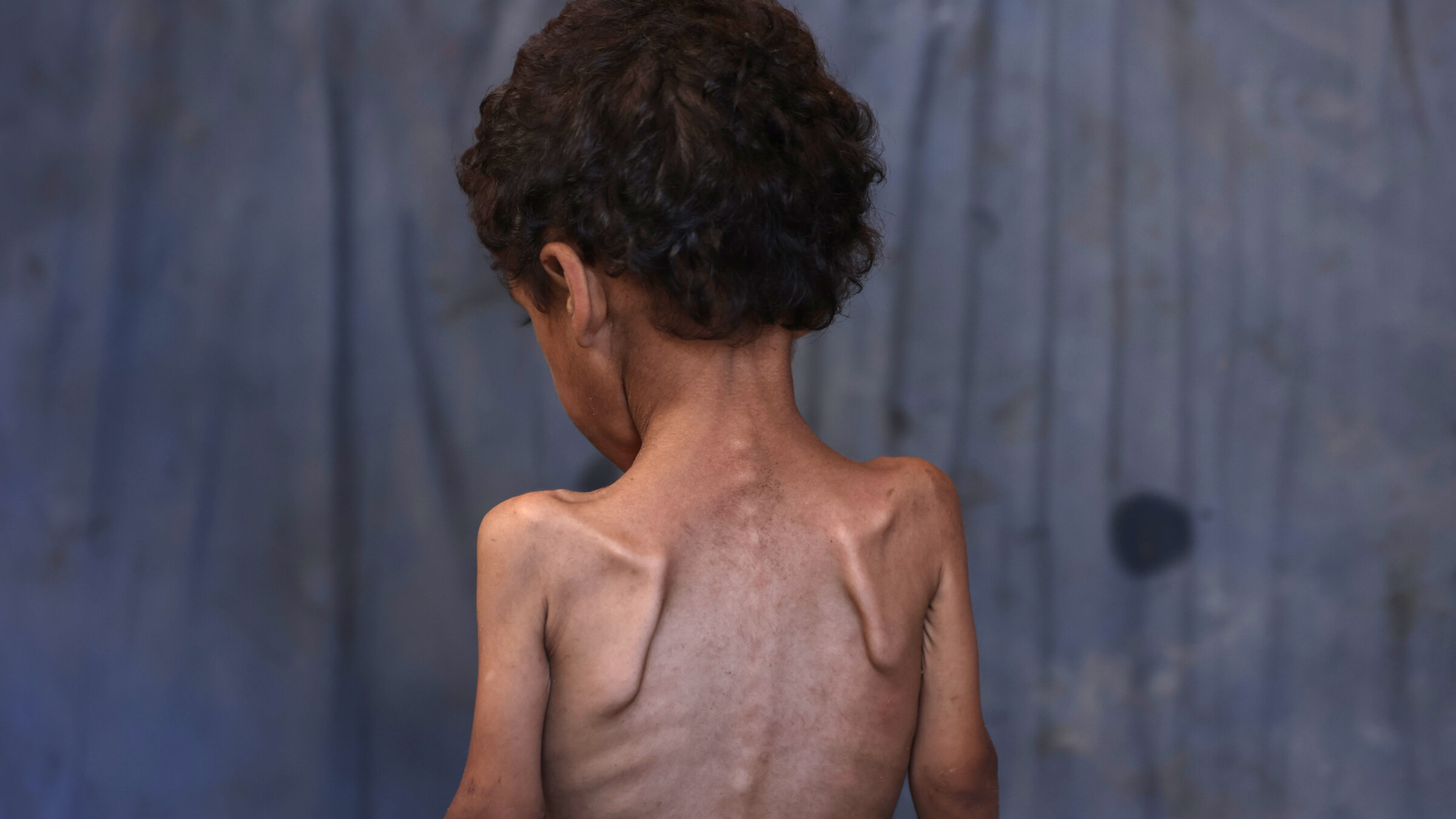 Yazan, a malnourished 2-year-old Palestinian boy, stands with his back turned in his family's damaged home in the Al-Shati refugee camp in Gaza on July 23.